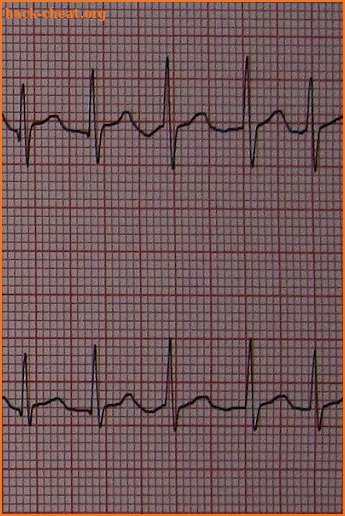 Atrial fibrillation screenshot