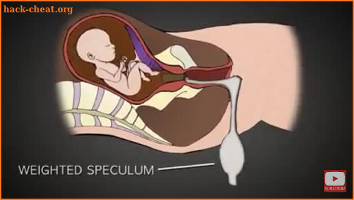 Before Abortion Info English screenshot