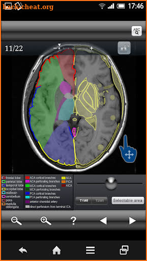 Brain MRI Sectional Wlker screenshot