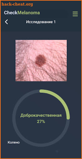 Check Melanoma screenshot