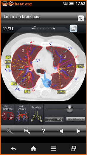 Chest CT Sectional Walker screenshot