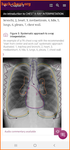 Chest X-Ray Interpretation screenshot