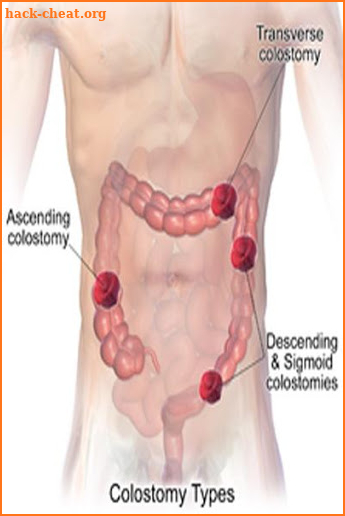 Colostomy screenshot