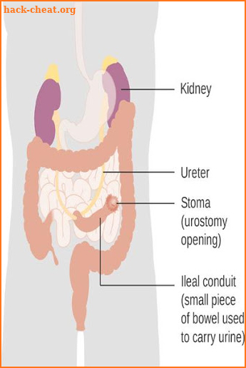 Colostomy screenshot