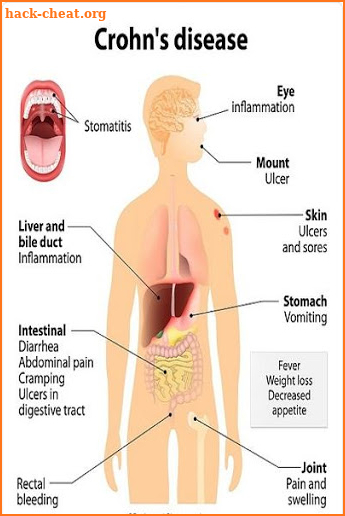 Crohn's Disease screenshot