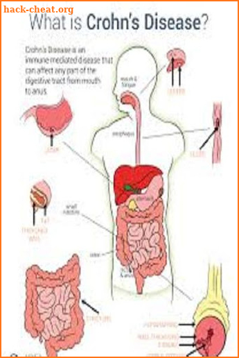 Crohn's Disease screenshot