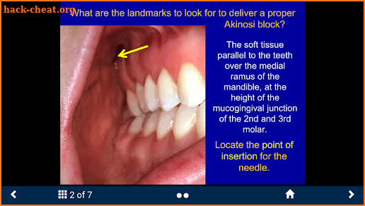 Dental Anesthesia - SecondLook screenshot