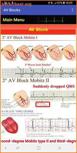 Easy Arrhythmias screenshot