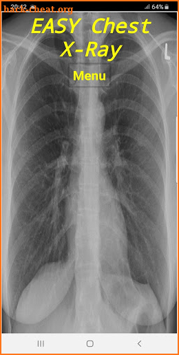 Easy Chest X-Ray screenshot