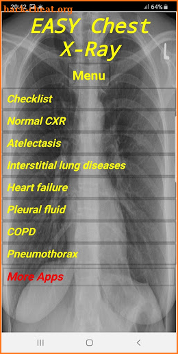 Easy Chest X-Ray screenshot