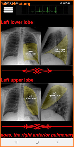 Easy Chest X-Ray screenshot