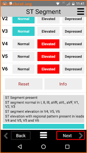 ECG CALC screenshot