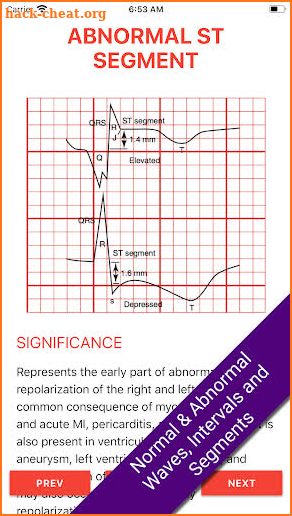 ECG FlashCards 2 - Reference App Most common EKGs screenshot