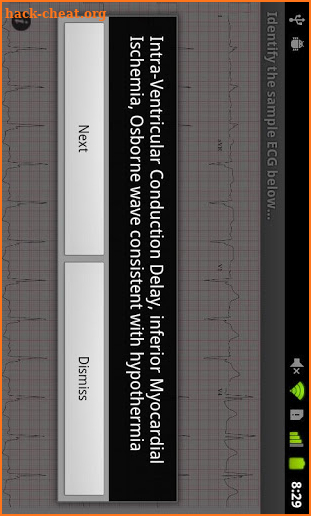 ECG Guide by QxMD screenshot