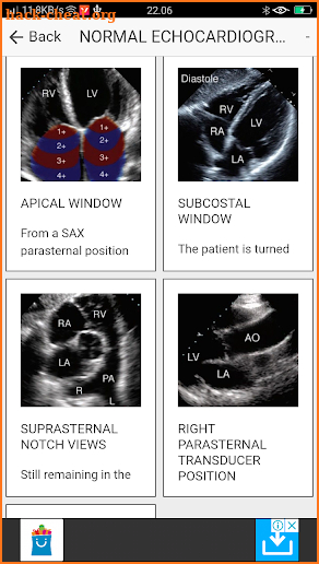 ECHOCARDIOGRAPHY GUIDE screenshot