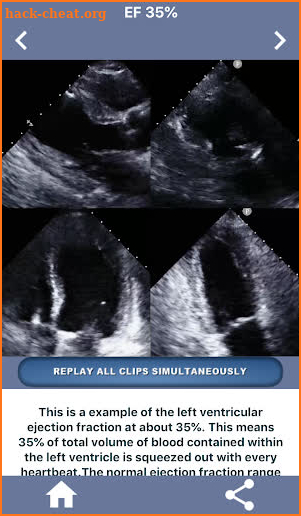 HEART EJECTION FRACTION: HOW TO EYEBALL THE EF screenshot