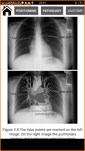 Interpretation Chest X Ray screenshot