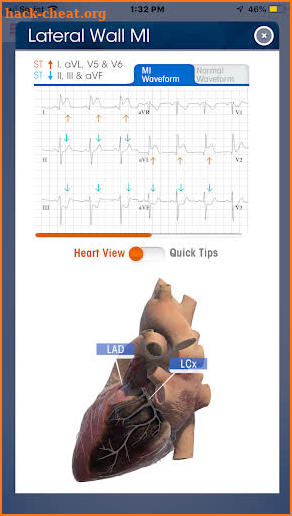 NK ECG Wheel App screenshot