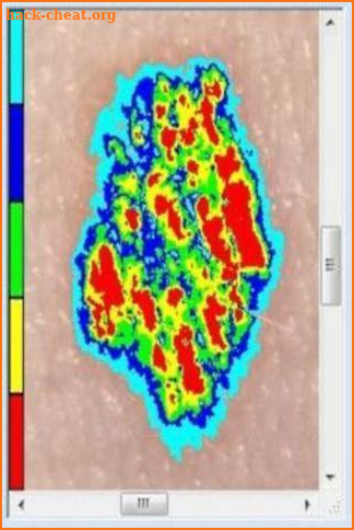 Skin Mole Analysis screenshot