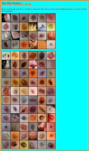 Skin Mole Analysis screenshot