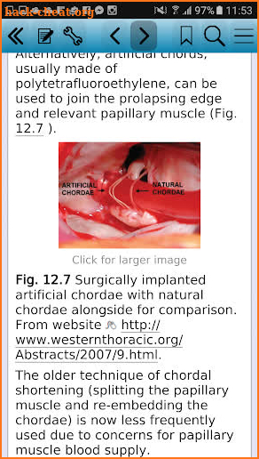 Valvular Heart Disease screenshot