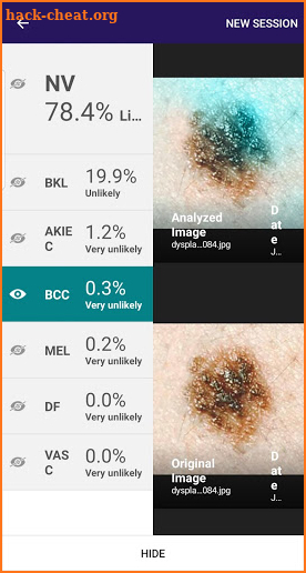 Visus: Skin Cancer Detection screenshot