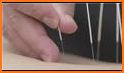 Hand Acupuncture related image