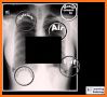 Interpret Chest X-Ray With 100 Cases related image