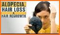 Alopecia Treatment- Home Remedies For Hair Growth related image