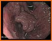 Endoscopic Classifications related image