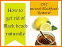 Get Rid Of Blackheads Naturally - 12 Home Remedies related image