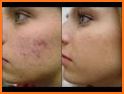 como curar el acne related image