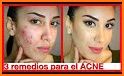 como curar el acne related image