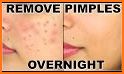 Prevent Acne Tips related image