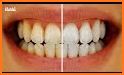 Tips Dientes Blancos related image