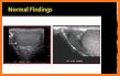 Scrotal Ultrasound related image