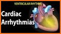 Easy Arrhythmias related image