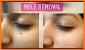 Avoid Mole related image