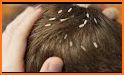 Head Lice related image