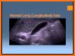 ULTRASOUND GALLBLADDER AND PHATOLOGY related image