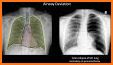 Chest X-Ray Interpretation related image