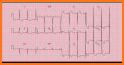 ECG Basics - Learning and interpretation made easy related image