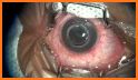 Eye Transplant Surgery Hospital Doctor related image