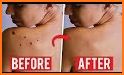 Skin tags Treatment and Home Remedies To Remove related image