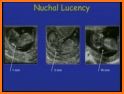 2nd & 3rd trimester OB/GY Ultrasound related image