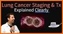 Lung Cancer Stage related image