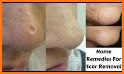 Face Blemishes Remover & Photo Scars Remover related image