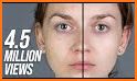 Beauty : Face Blemishes Removal related image