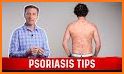 Psoriasis natural treatment related image