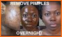 Acne & Pimples (Home Remedies) related image